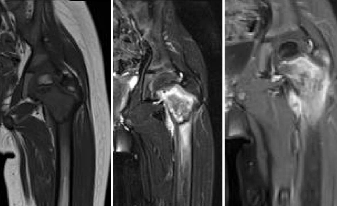 Figure 2 for case Langerhans cell histiocytosis ( RID3846 )